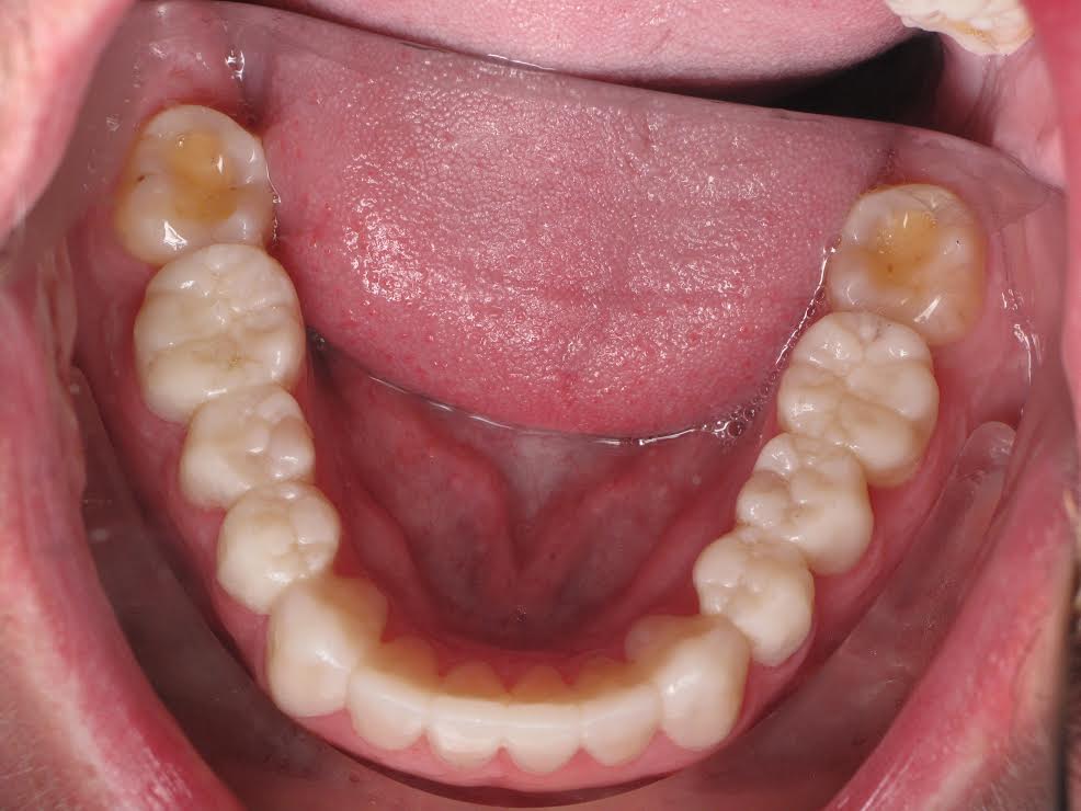after a patient had his teeth scaled