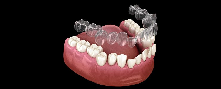 img-clearcorrect-aligners 3D dental model showing upper and lower teeth with implants and prosthetic denture structure.