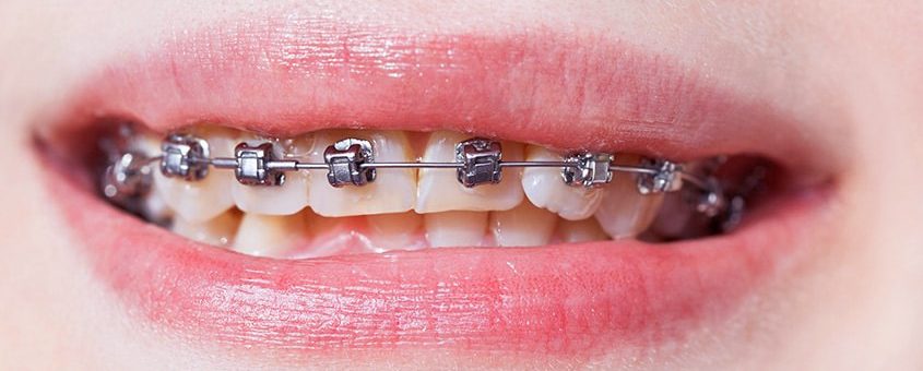 Close-up of metal braces on upper teeth showing orthodontic treatment progress.