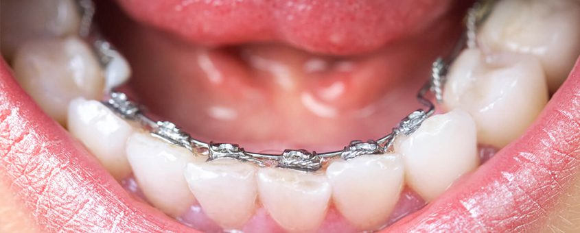 Close-up of lower teeth with dental braces showing orthodontic treatment in progress.