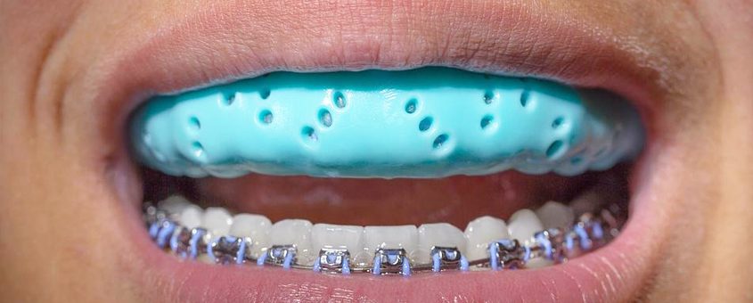 Close-up of smile showing metal braces on lower teeth with blue orthodontic appliance.