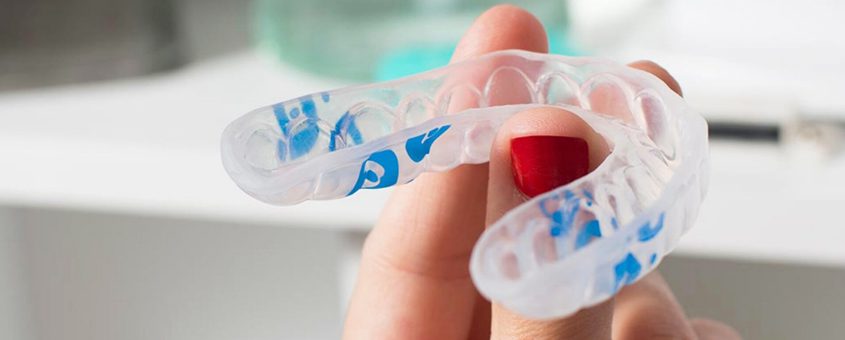 Hand holding clear dental aligners with blue markings against bright clinical background