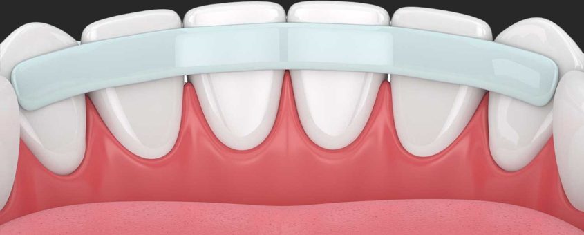 img-periodontal-splint Illustration of upper front teeth and pink gum tissue showing dental anatomy for CopperMine Dental Studio.