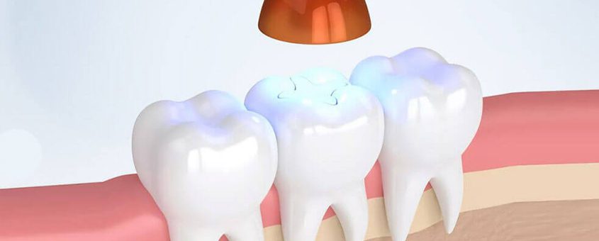img-tooth-colored-fillings-2 Three white teeth with blue and purple light therapy caps in dental office setting.