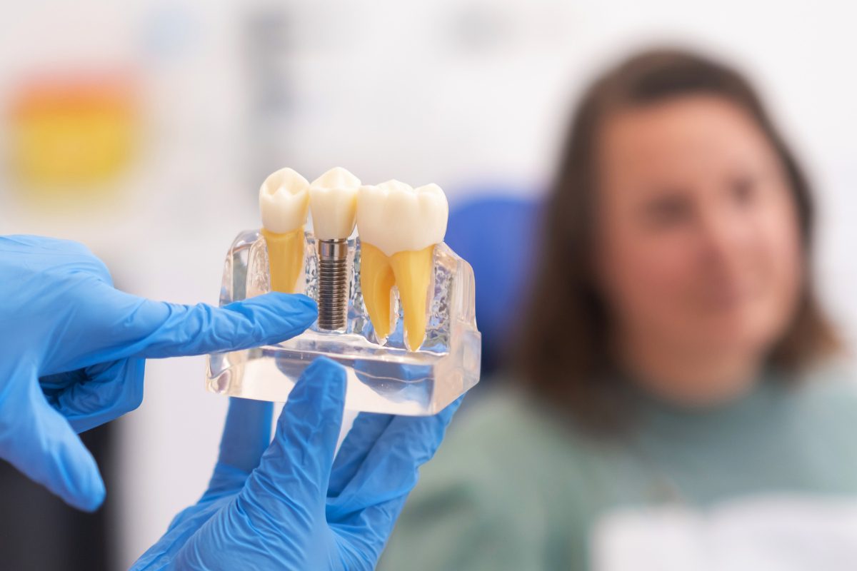 Dental Implants Dental Implants
