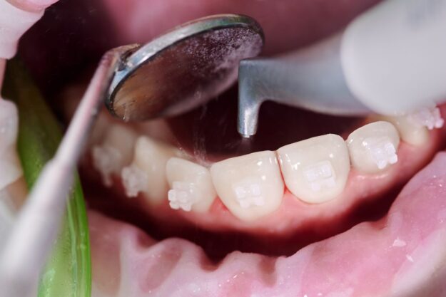 Procedure of professional dental cleaning in Green Valley.