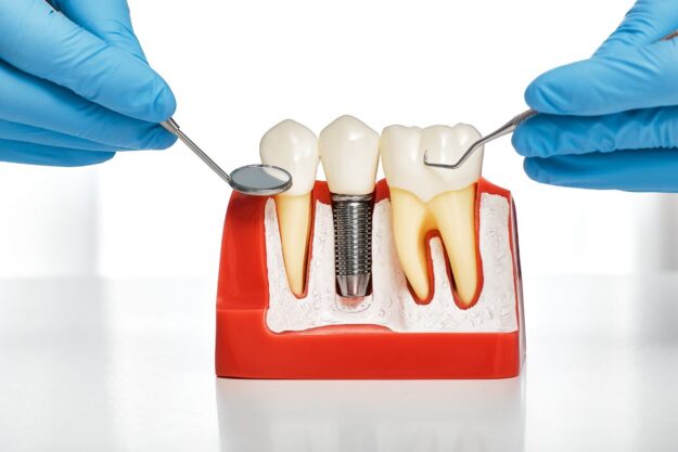 Dental implant model showing an artificial tooth with dental tools.