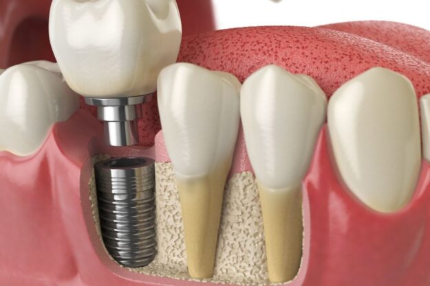 Cross-sectional view of a dental implant surrounded by healthy gums.
