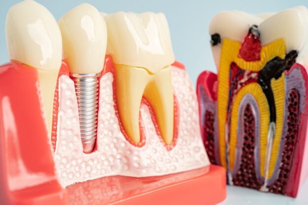 Dental implant model with signs of implant complications.