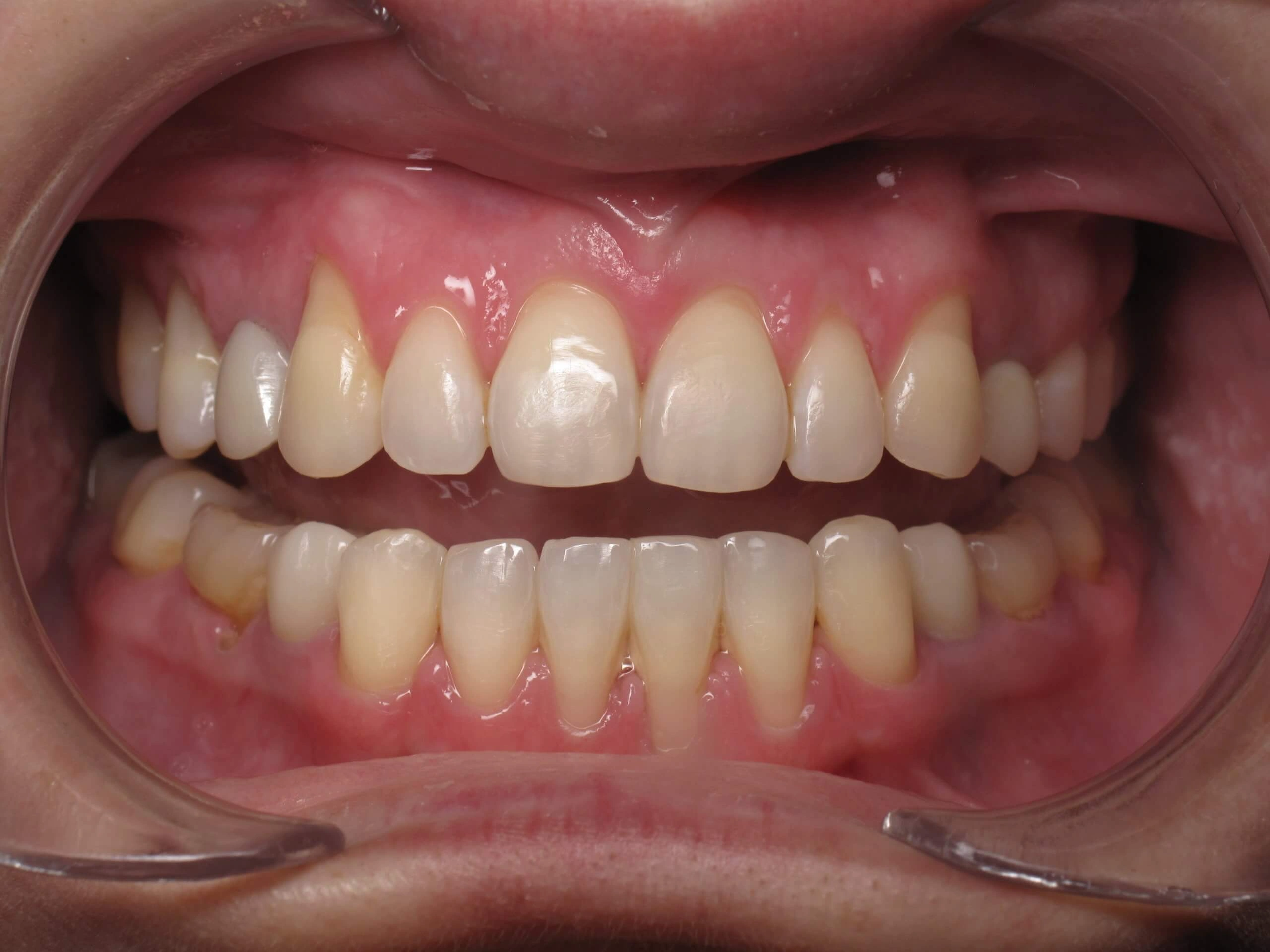 After Patient 1