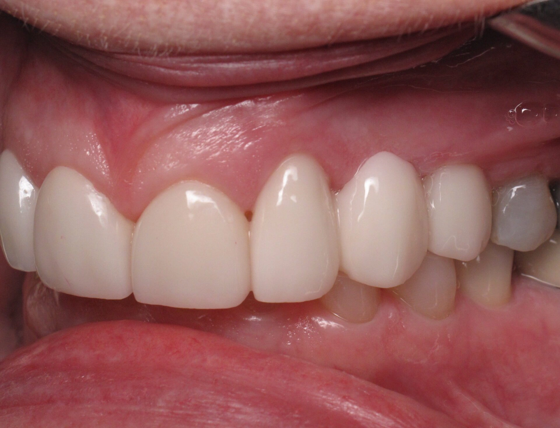 After Patient 3