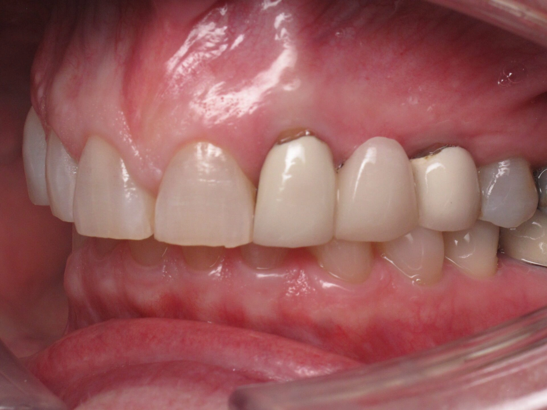 Before Patient 3