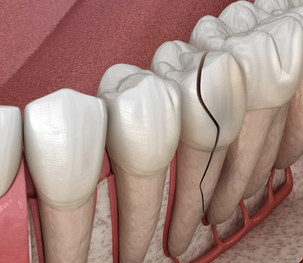 Repairing Chipped or Broken Teeth