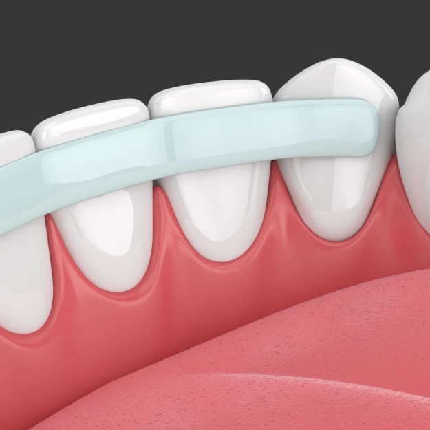 Cosmetic Dental Bonding Saves Money