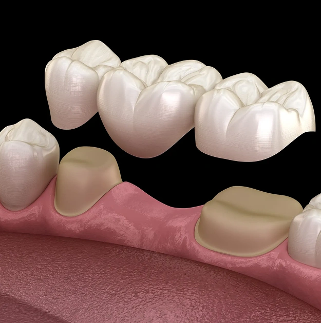 Restoring the Function of Your Natural Teeth
