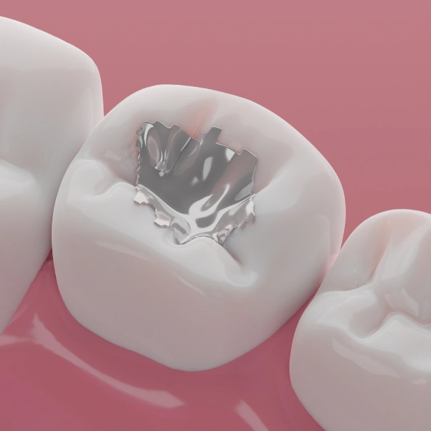 What Dental Fillings Do for Your Teeth