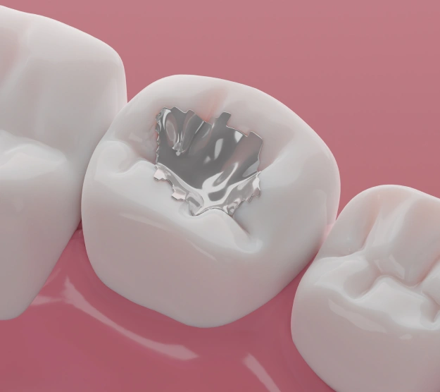 What is a Dental Filling