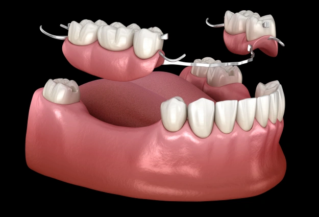 Filling the Gaps in Patients’ Teeth