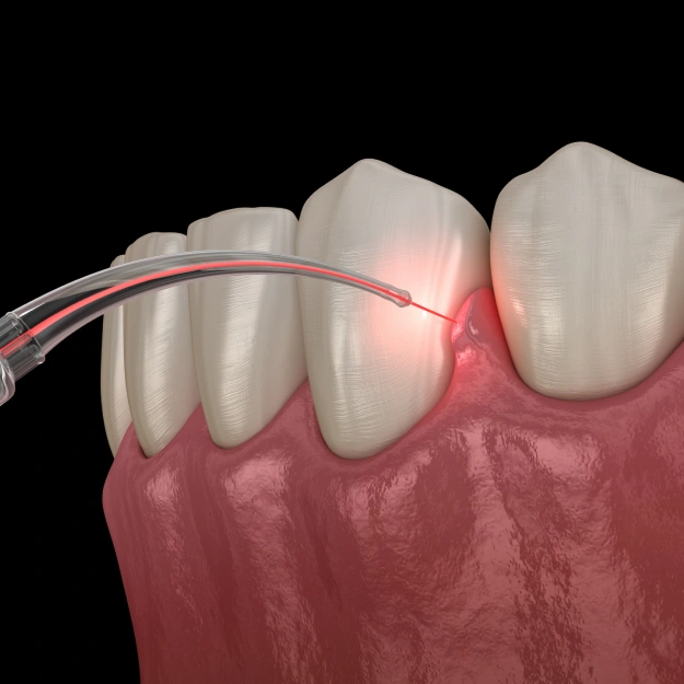 Gingivectomy A Solution for Gum Disease