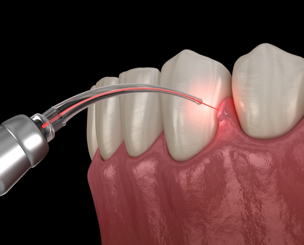 Combating Gum Disease With Gingivectomy
