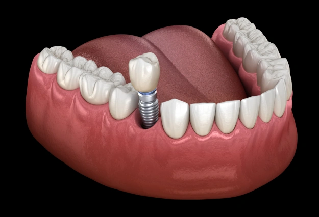 When Dental Implants Get Damaged