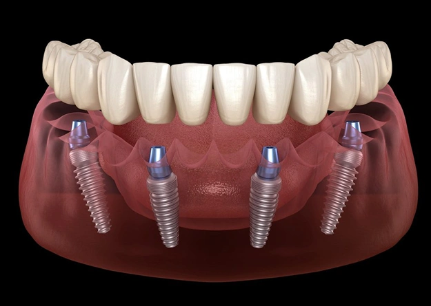 Stable, Comfortable, and Natural Looking Dentures