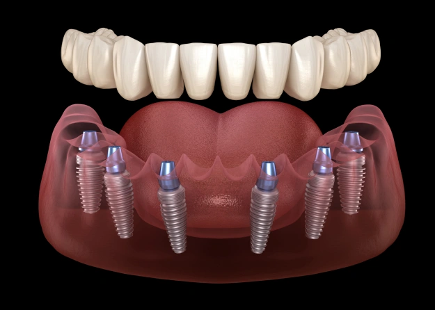 The Magic of Implant-Retained Dentures