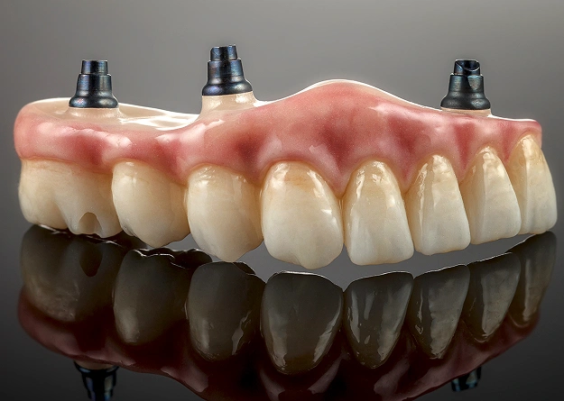 Why Choose Implant-Retained Partial Dentures?