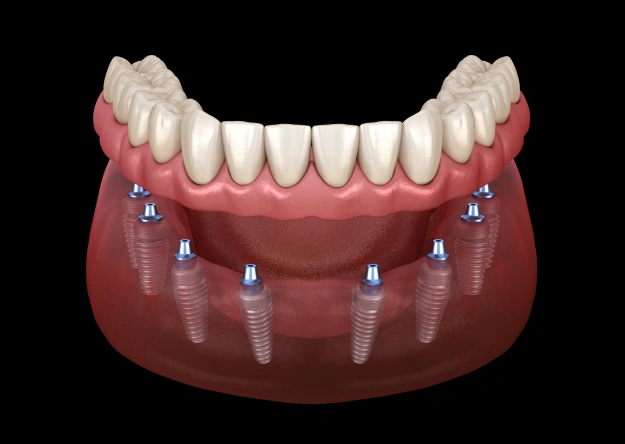 The Magic of Implant-Retained Partials