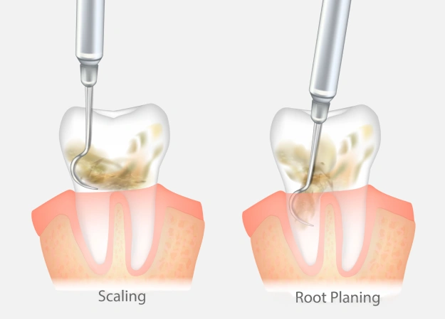 Treatment for Periodontitis and Gum Disease