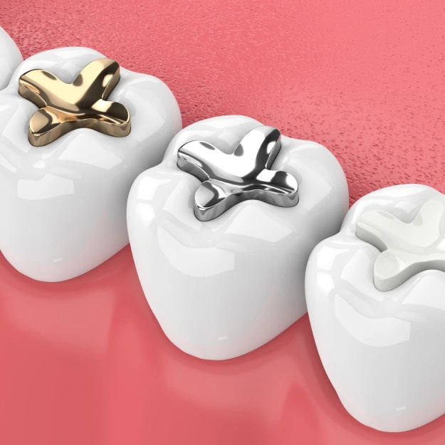 Benefits of Choosing Tooth-Colored Fillings