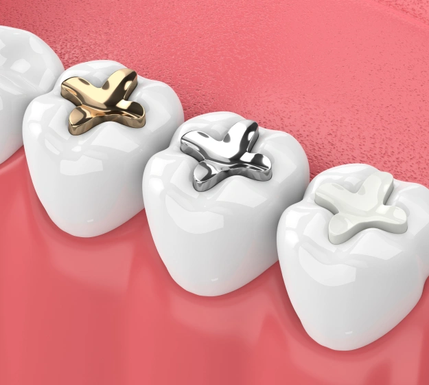 Why Our Doctors Recommend Tooth-Colored Fillings