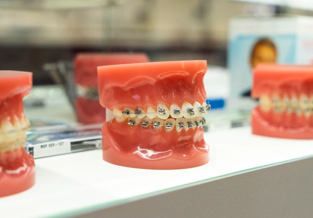 Braces on dental model demonstrating orthodontic treatment and teeth alignment.